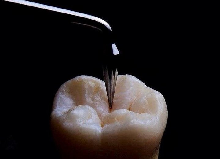 Кариес и его осложнения