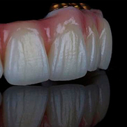 Керамический протез всех зубов