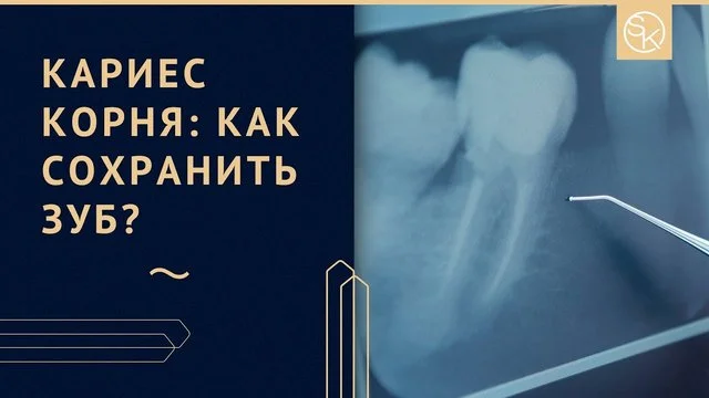 Видео о кариесе корня зуба