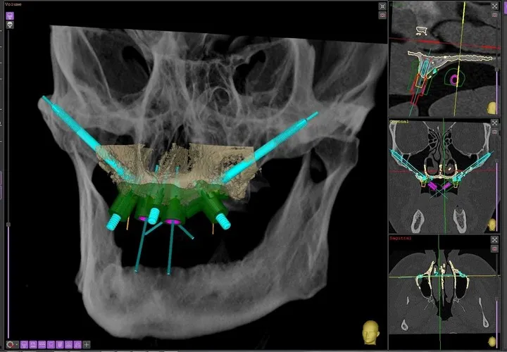 3D-планирование имплантации