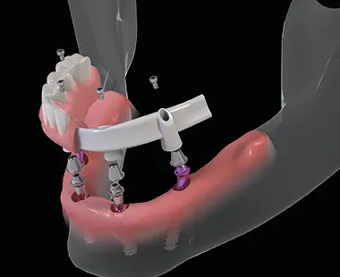 Все зубы на 4 имплантах Straumann