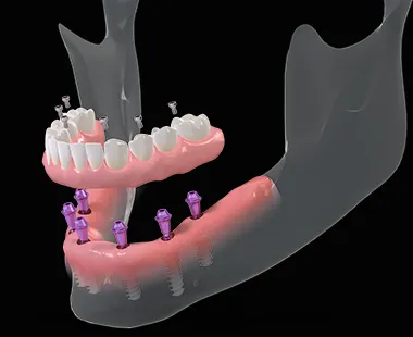 Все зубы на 6 имплантах Straumann