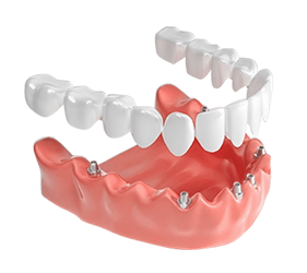 Все зубы за 1 день на 6 имплантах Nobel Biocare