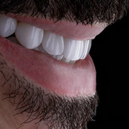Виниры на зубах у мужчины