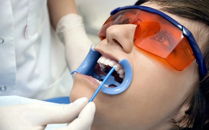 Укрепление эмали и контроль результата