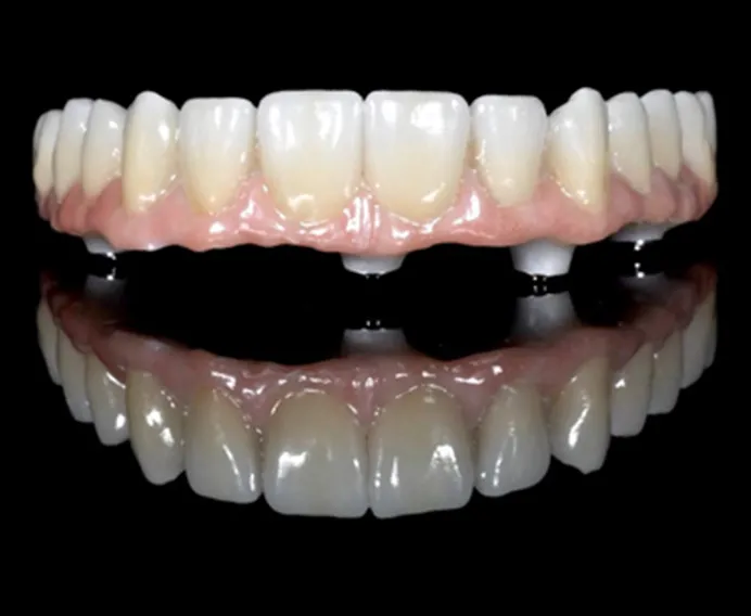 All-on-4 – все зубы на 4 имплантах (Nobel Biocare)