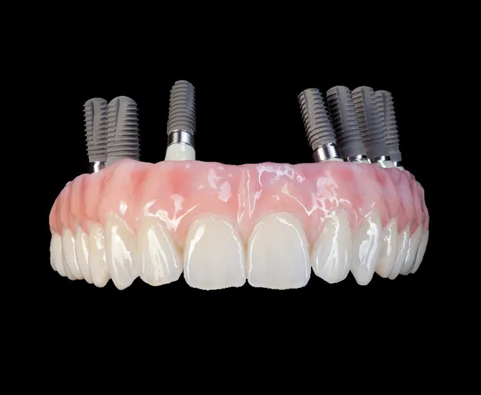 ProArch все зубы на 4-6 имплантах Straumann