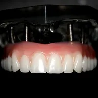 восстановление зубов всей челюсти