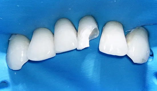 Восстановление после скола зуба - до