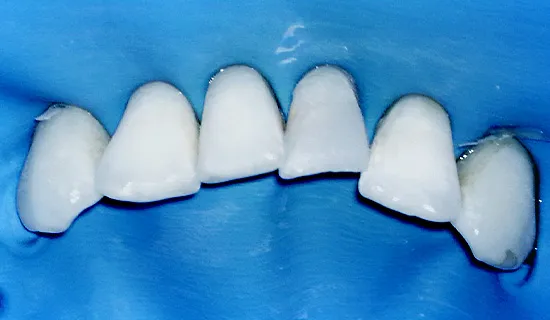 Восстановление после скола зуба - после