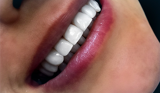 После отбеливания зубов
